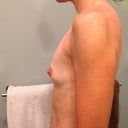 Pre-op