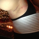 Armpit incision. 4 days post op.