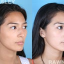 Rhinoplasty Patient