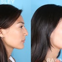 Rhinoplasty Patient