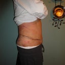 3 days post-op.