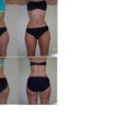 Side by side before and after. 3 weeks post op.