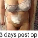 front view, before before to 19 days postop