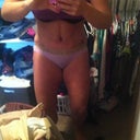 Post op day 1 without binder