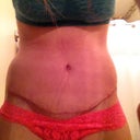 17 DPO: my incision from the font. Healing very nicely. I love how low it is in the front, and how Dr. T blended it with the curves/contours of my body.