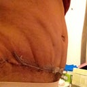 A BIG dense on my right side