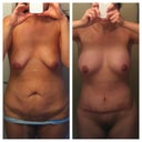 Pre-Op and 6 weeks 6 days PO side by side. I made this in an attempt to cheer myself up.  Looks pretty good but I still can't get over the rolls when I sit down.