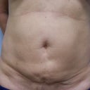 Revision Tummy Tuck With Abdominal  Liposuction