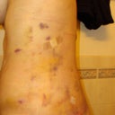 Bruising - 2 days after surgery