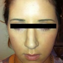 Post op 17 days after Revison Rhino