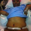 Still very swollen it only gets better after the swelling goes down!!!