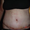 8 days post op very very swollen