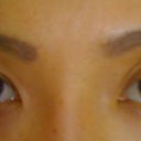 After Fat Transfer Surgery