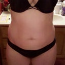 Before picture taken the morning of surgery