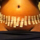 new belly....7 days post op!