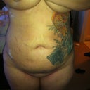 Front, day 3 post op