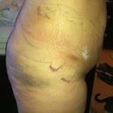 Side,day 3 post op