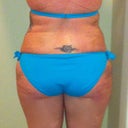 Rear, day 3 post op