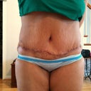 6.28.11 Knew the stretch marks would stay,but today the scar really started looking lifted and puckered, is this normal?! Will it go away?