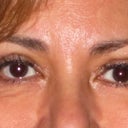 After Upper Bleph.  (2 wks po)