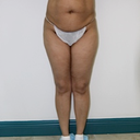 front pre op
