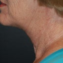 Direct Excision Neck Lift In A 70 Year Old (T-Z Plasty)