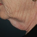 Direct Excision Neck Lift In A 70 Year Old (T-Z Plasty)