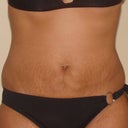 front4 days post op