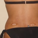 back/flanks 4 days post op