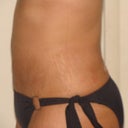 left side view 4 days post op