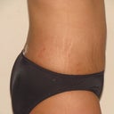 right side view 4 days post op