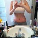 Post tt day 8. Got the drains out today!!! I feel as if the scar has raised.