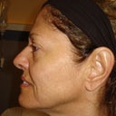 Pre-surgery side view