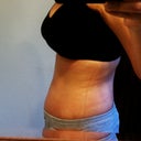 23 days post op. Still swollen but going down after losing 5 pounds.