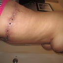 left side of my gnarly infectious looking scar.