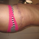 right side of my other scar