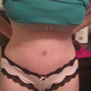 10 days post op. Swollen and tight so not able to stand straight yet