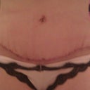The "scar" 10 days post op.  Can't wait till they heal so I get the ok from my PS to use a scar cream!
