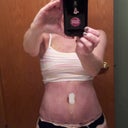 5DPO swollen yet feeling so much better than before! So worth the $$, discomfort, etc.
