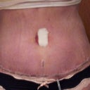 See my old bb hole above the incision. I did not have enough skin to remove it so it just gets sown shut.