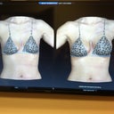 3d image of what i will look like with the implants