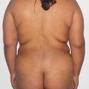 28 Years Old Female Treated For Lipodistrofy On Her Back ( Fat Exces On Her Back)