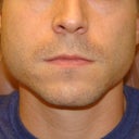 1: Pre-Botox
