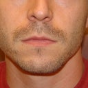 4: Two month follow-up