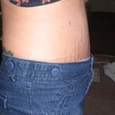 3 weeks, side view, can't wait to see reults once the swelling actually goes down!