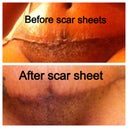 Scar Away silicone scar sheets