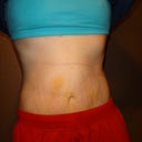 After!!!!  6 Days PO.  The redness is from my binder.  Belly button is my original.  I was set on keeping it and my surgeon was awesome in helping me do so!