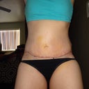 Incision 6 Days Post Op