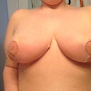 almost 3 weeks post op. (19 days)