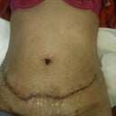 2 days post op